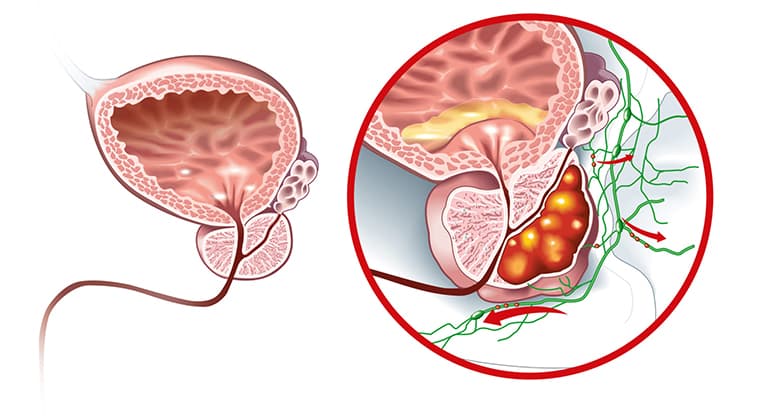 Cáncer de próstata