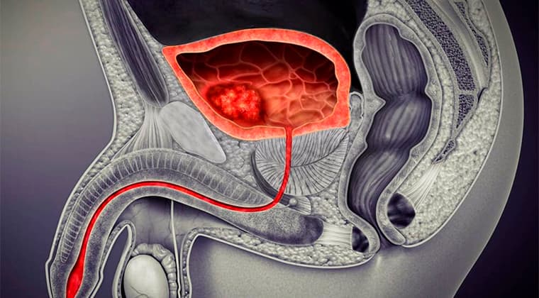 Cáncer de vejiga