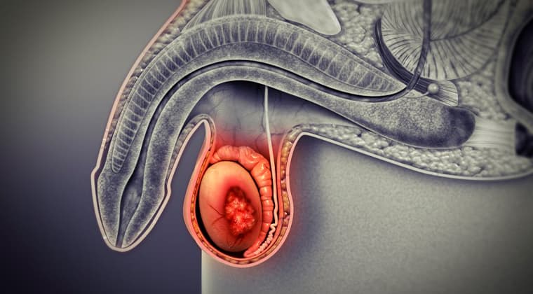 Cáncer testicular