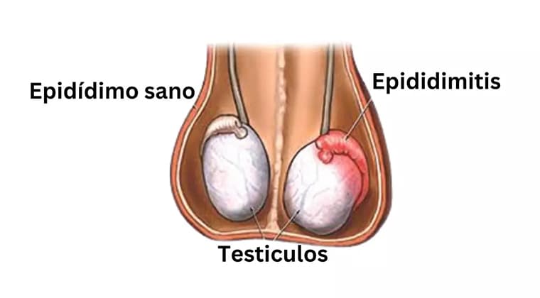 Epididimitis