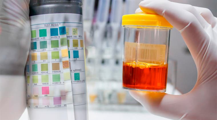 Hematuria (Sangre en la orina)
