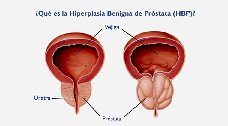 Hiperplasia benigna de próstata (HBP)