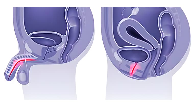 Uretritis