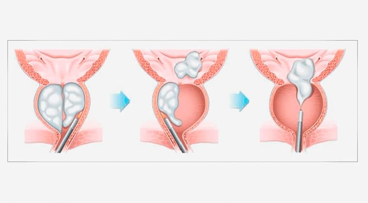 Enucleación Prostática con Láser Holmium (HoLEP)