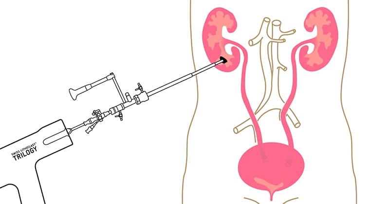 Nefrolitotomía Percutánea (NLPC)