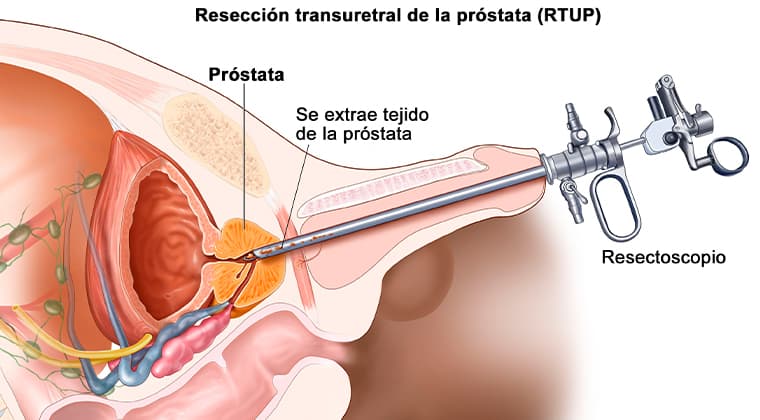 Resección Transuretral de Próstata (RTUP)