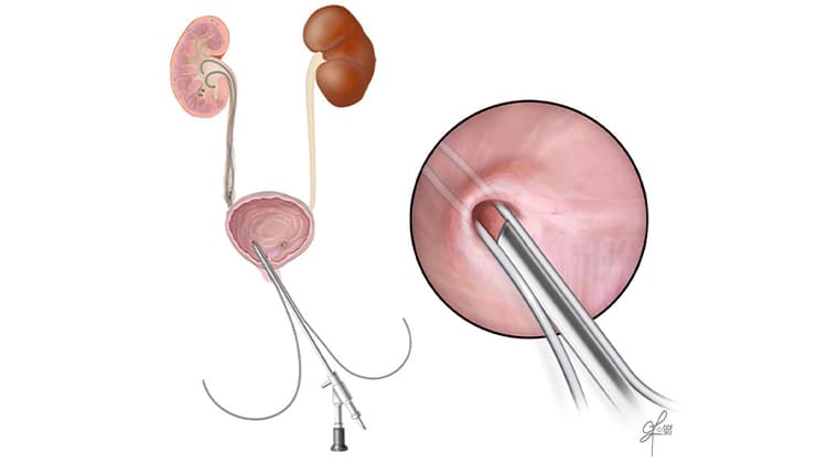 Ureteroscopia Semirrígida