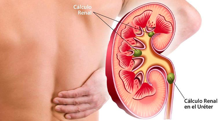 Cálculos renales (Litiasis renal)