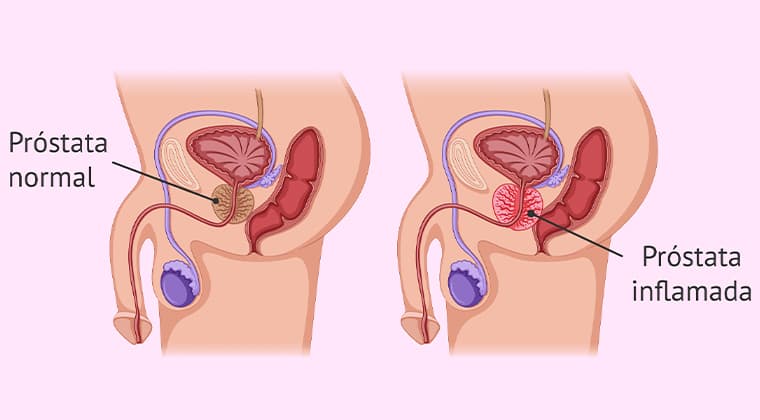 Prostatitis