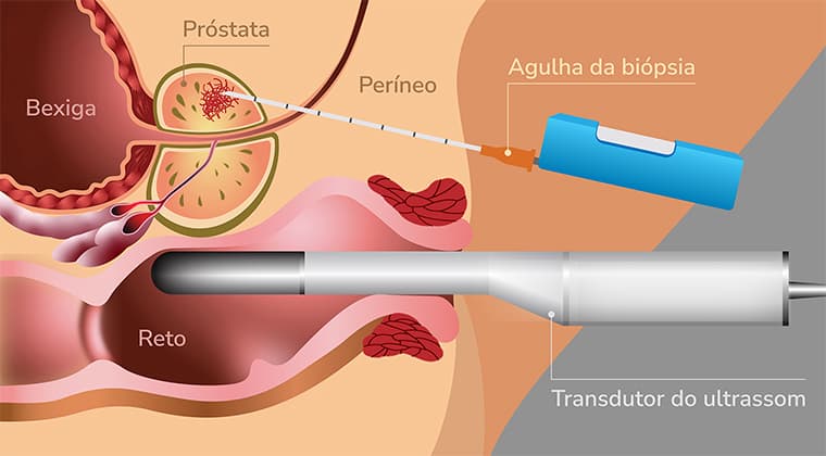 Biopsia Transperineal de Próstata