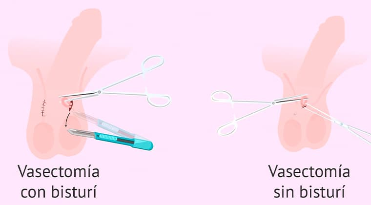 Vasectomía sin Bisturí
