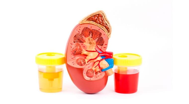 Sangre en la orina (Hematuria)